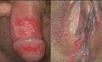 Illustration for article titled obat untuk sakit kulit herpes